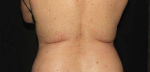 CoolSculpting - Case #1 Before